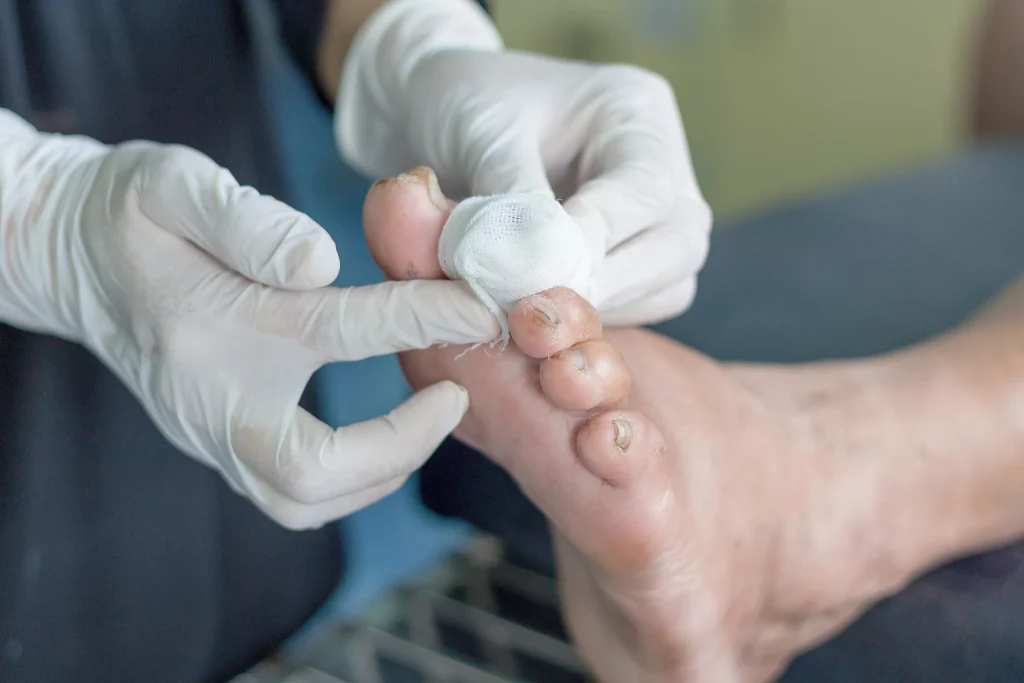 Diabetisches Fußsyndrom